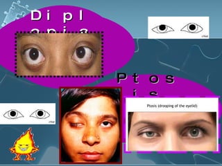 Diplopia Ptosis 