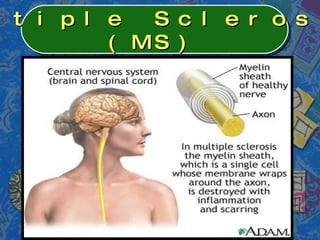 Multiple Sclerosis (MS)  