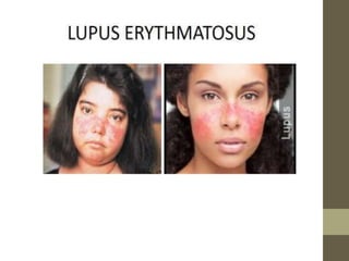 Autoimmune disorders