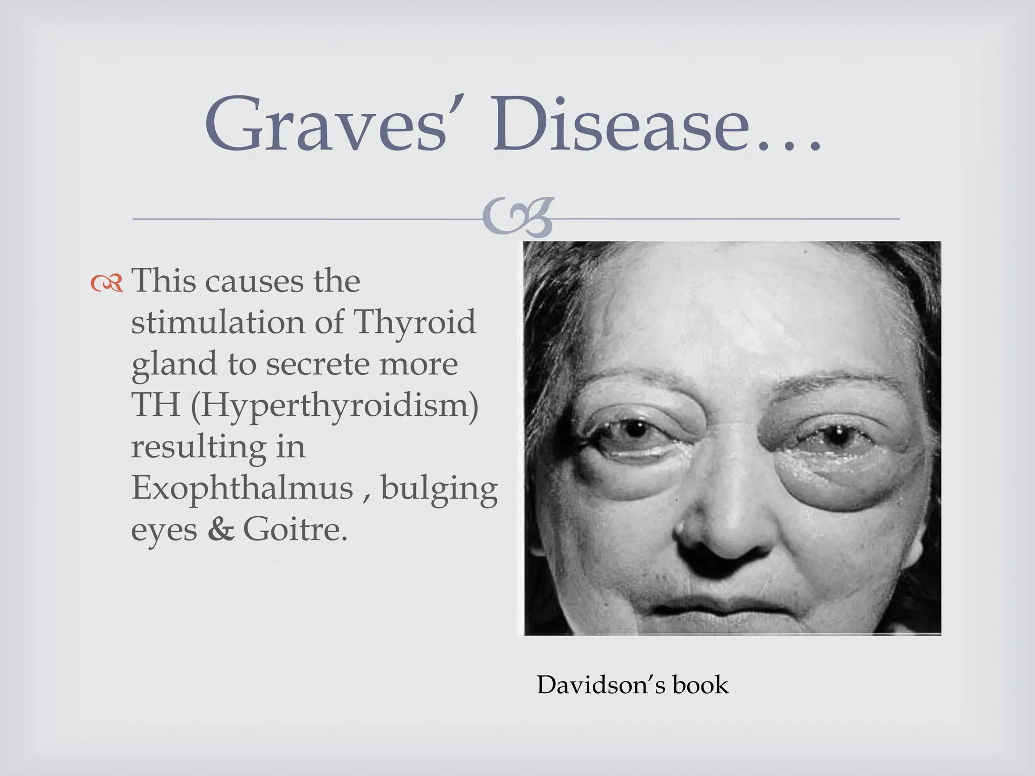
 This causes the
stimulation of Thyroid
gland to secrete more
TH (Hyperthyroidism)
resulting in
Exophthalmus , bulging
eyes & Goitre.
Graves’ Disease…
Davidson’s book
 