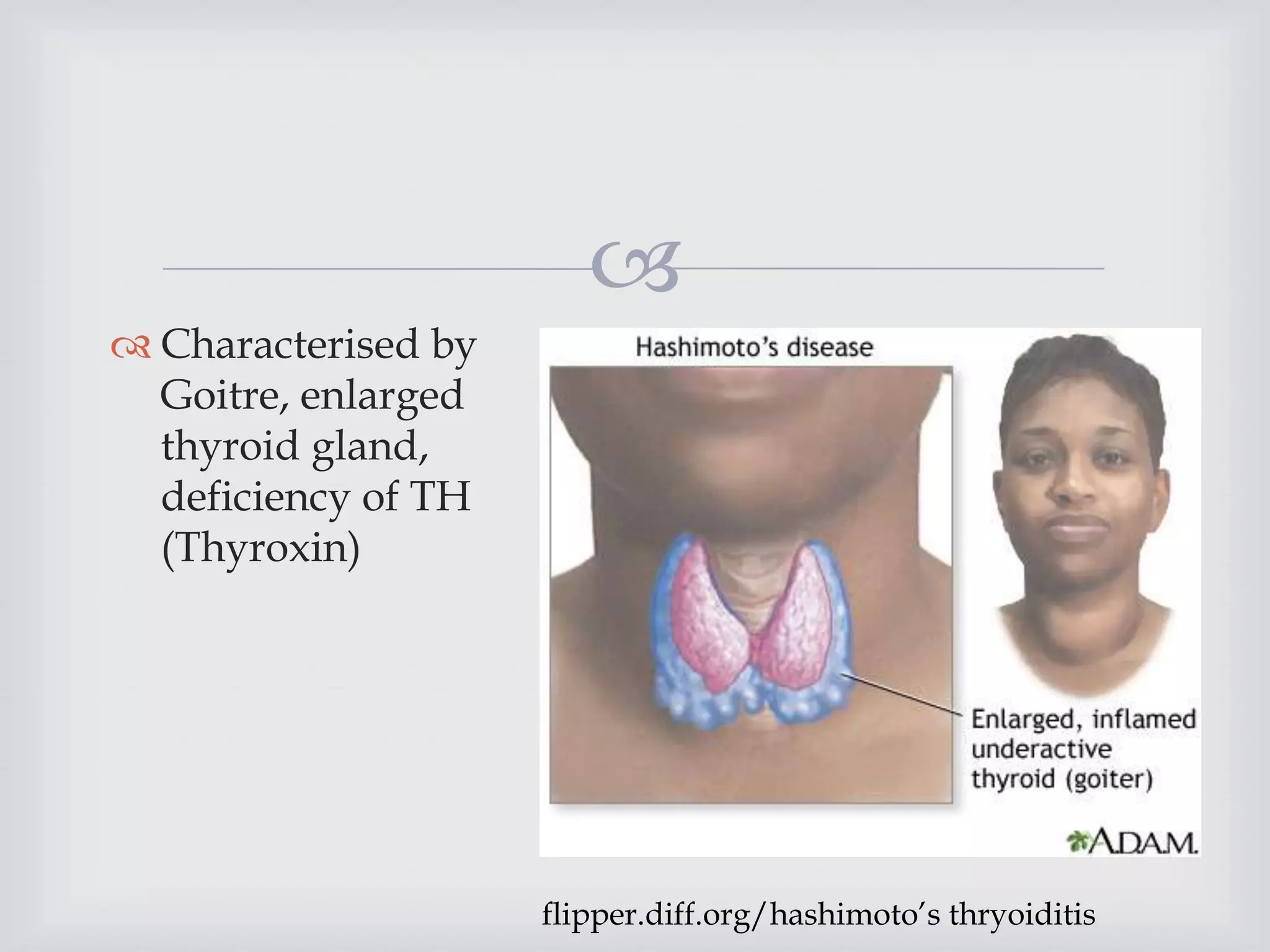 
 Characterised by
Goitre, enlarged
thyroid gland,
deficiency of TH
(Thyroxin)
flipper.diff.org/hashimoto’s thryoiditis
 