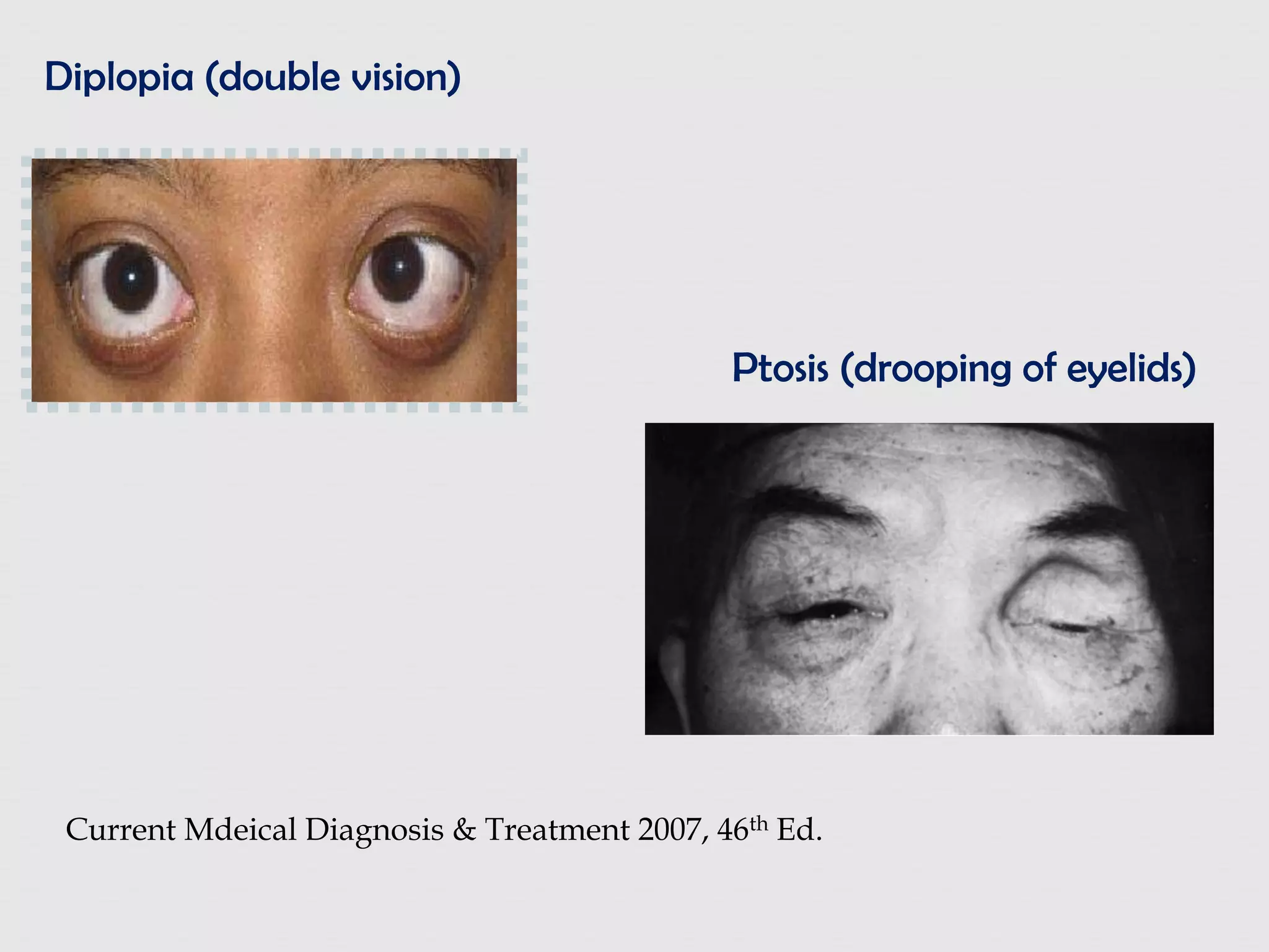 Diplopia (double vision)
Ptosis (drooping of eyelids)
Current Mdeical Diagnosis & Treatment 2007, 46th Ed.
 