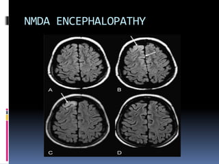 NMDA ENCEPHALOPATHY
 