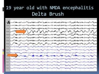 19 year old with NMDA encephalitis
Delta Brush
 