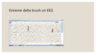 Extreme delta brush on EEG
 