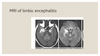 MRI of limbic encephalitis
 