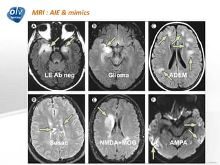 MRI : AIE & mimics
Jo Caekebeke
LE Ab neg Glioma ADEM
Susac NMDA+MOG AMPA
 