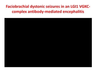 Faciobrachial dystonic seizures in an LGI1 VGKC-
complex antibody-mediated encephalitis
 