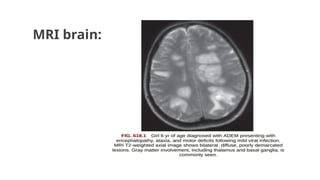 MRI brain:
 