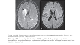 A) FLAIR MRI image of a patient with anti-NMDAR encephalitis and concurrent MOG antibodies; it shows a prominent right
frontal abnormality compatible with demyelination.
B) T1-weighted MRI image of a 2-yr-old male with anti-NMDAR encephalitis after herpes simplex encephalitis. There are
extensive necrotic areas in temporal regions that are residual from the viral encephalitis, without new MRI lesions produced by
the autoimmune encephalitis
 