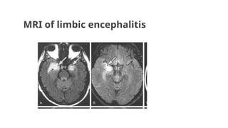 MRI of limbic encephalitis
 