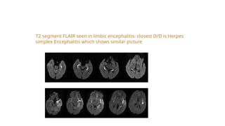 T2 segment FLAIR seen in limbic encephalitis- closest D/D is Herpes
simplex Encephalitis which shows similar picture
 