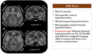 Autoimmune Epilepsies.pptx