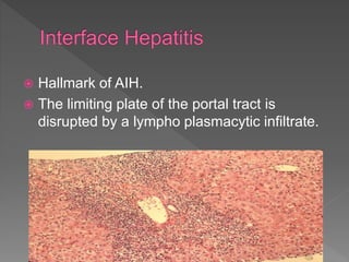  Hallmark of AIH.
 The limiting plate of the portal tract is
disrupted by a lympho plasmacytic infiltrate.
 