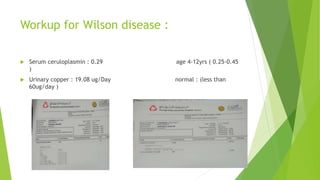 Workup for Wilson disease :
 Serum ceruloplasmin : 0.29 age 4-12yrs ( 0.25-0.45
)
 Urinary copper : 19.08 ug/Day normal : (less than
60ug/day )
 