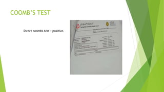 COOMB’S TEST
Direct coombs test : positive.
 