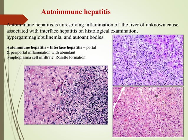 Autoimmune liver disease laboratory diagnosis | PPT
