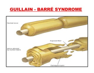 GUILLAIN - BARRÉ SYNDROME
 