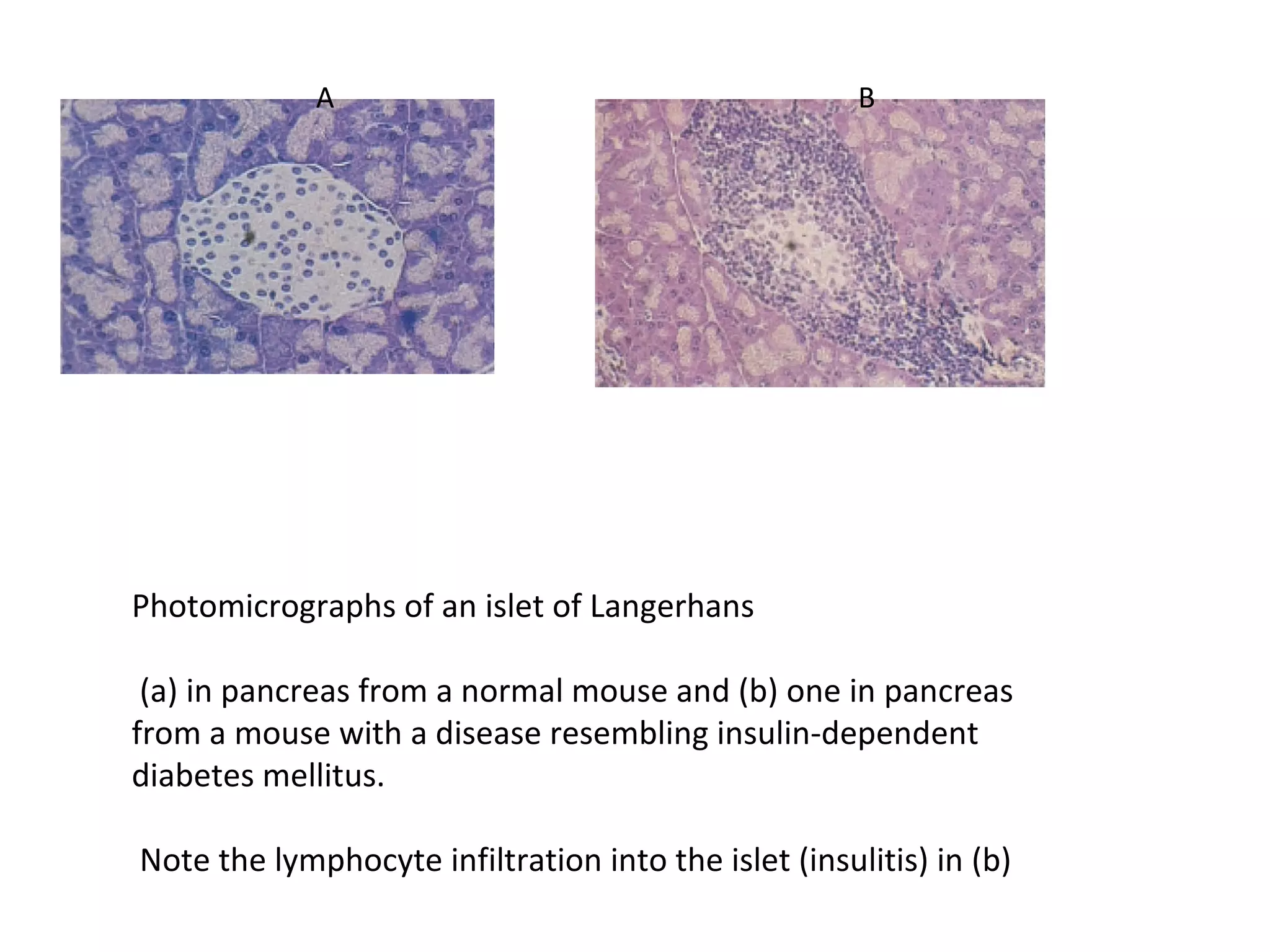 A B
Photomicrographs of an islet of Langerhans
(a) in pancreas from a normal mouse and (b) one in pancreas
from a mouse with a disease resembling insulin-dependent
diabetes mellitus.
Note the lymphocyte infiltration into the islet (insulitis) in (b)
 