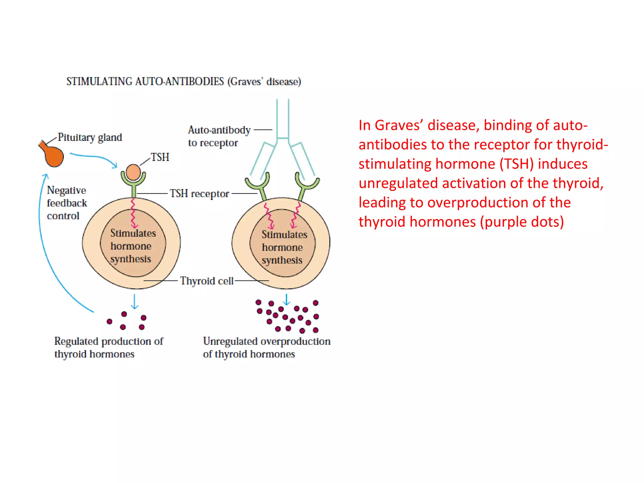 In Graves’ disease, binding of auto-
antibodies to the receptor for thyroid-
stimulating hormone (TSH) induces
unregulated activation of the thyroid,
leading to overproduction of the
thyroid hormones (purple dots)
 
