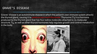 GRAVE’S DISEASE
Graves' disease is an autoimmune disease in which the patient's own immune system attacks
the thyroid gland, causing it to produce too much thyroxine.Thyroxine (T4) is a hormone
produced by the thyroid gland that has four iodine molecules attached to its molecular
structure.T4, as well as other thyroid hormones help regulate growth and control metabolism
in the body.
 