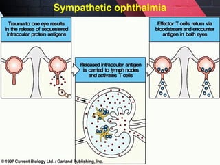 Sympathetic ophthalmia
 