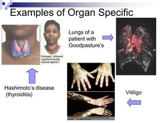 Examples of Organ Specific
Lungs of a
patient with
Goodpasture’s
Vitiligo
Hashimoto’s disease
(thyroiditis)
 
