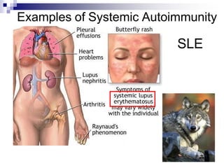 Examples of Systemic Autoimmunity
SLE
 