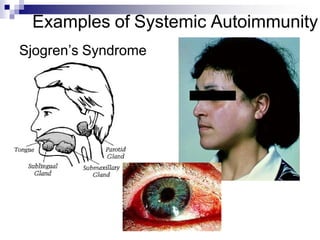 Examples of Systemic Autoimmunity
Sjogren’s Syndrome
 