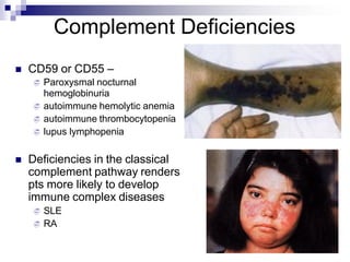 Complement Deficiencies
 CD59 or CD55 –
 Paroxysmal nocturnal
hemoglobinuria
 autoimmune hemolytic anemia
 autoimmune thrombocytopenia
 lupus lymphopenia
 Deficiencies in the classical
complement pathway renders
pts more likely to develop
immune complex diseases
 SLE
 RA
 