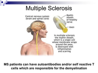 Multiple Sclerosis
MS patients can have autoantibodies and/or self reactive T
cells which are responsible for the demyelination
 