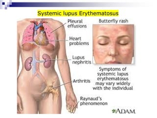 Systemic lupus Erythematosus
 