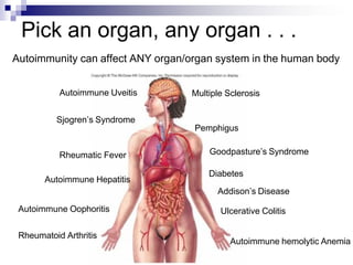 Pick an organ, any organ . . .
Autoimmunity can affect ANY organ/organ system in the human body
Pemphigus
Multiple Sclerosis
Sjogren’s Syndrome
Rheumatic Fever
Autoimmune Hepatitis
Ulcerative Colitis
Goodpasture’s Syndrome
Autoimmune Uveitis
Autoimmune hemolytic Anemia
Diabetes
Addison’s Disease
Rheumatoid Arthritis
Autoimmune Oophoritis
 