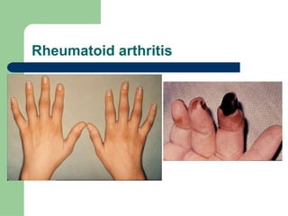 Comprehensive Overview of Autoimmune Diseases: Mechanisms ...