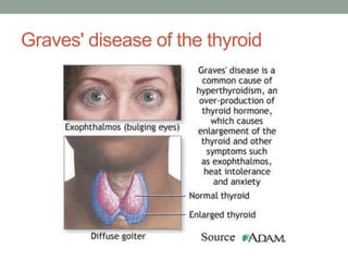 Graves' disease of the thyroid
 