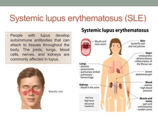 Systemic lupus erythematosus (SLE)
• People with lupus develop
autoimmune antibodies that can
attach to tissues throughout the
body. The joints, lungs, blood
cells, nerves, and kidneys are
commonly affected in lupus.
 