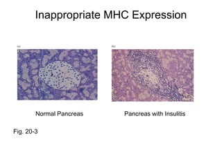 Inappropriate MHC Expression
Normal Pancreas Pancreas with Insulitis
Fig. 20-3
 