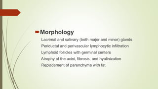 Morphology
Lacrimal and salivary (both major and minor) glands
Periductal and perivascular lymphocytic infiltration
Lymphoid follicles with germinal centers
Atrophy of the acini, fibrosis, and hyalinization
Replacement of parenchyma with fat
 