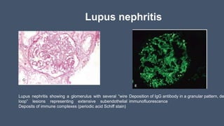 Lupus nephritis
Lupus nephritis showing a glomerulus with several “wire
loop” lesions representing extensive subendothelial
Deposits of immune complexes (periodic acid Schiff stain)
Deposition of IgG antibody in a granular pattern, de
immunofluorescence
 