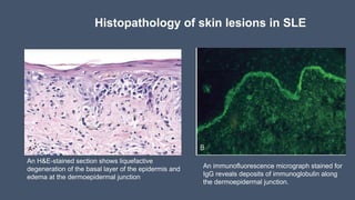 Histopathology of skin lesions in SLE
An H&E-stained section shows liquefactive
degeneration of the basal layer of the epidermis and
edema at the dermoepidermal junction
An immunofluorescence micrograph stained for
IgG reveals deposits of immunoglobulin along
the dermoepidermal junction.
 