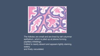 The follicles are small and are lined by tall columnar
epithelium, which is piled up at places forming
papillary infoldings.
Colloid is nearly absent and appears lightly staining,
watery
and finely vacuolated.
 