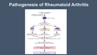 Pathogenesis of Rheumatoid Arthritis
 