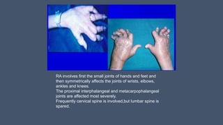 RA involves first the small joints of hands and feet and
then symmetrically affects the joints of wrists, elbows,
ankles and knees.
The proximal interphalangeal and metacarpophalangeal
joints are affected most severely.
Frequently cervical spine is involved,but lumbar spine is
spared.
 