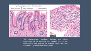 The characteristic histologic features are villous
hypertrophy of the synoviuM and marked mononuclear
inflammatory cell infiltrate in synovial membrane with
formation of lymphoid follicles at places
 