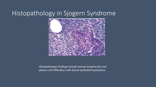 Histopathology in Sjogern Syndrome
Histopathologic findings include intense lymphocytic and
plasma cell infiltration with ductal epithelial hyperplasia.
 