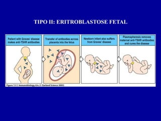 Figure II: ERITROBLASTOSE FETAL
   TIPO 13-5




2001/2002     Prof. Doutor José Cabeda   Imunologia
 