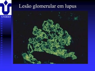 Lesão glomerular em lupus
UNIRIO




         2001/2002       Prof. Doutor José Cabeda   Imunologia
 