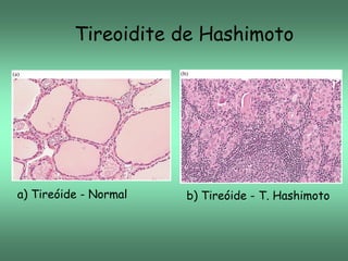 Tireoidite de Hashimoto

a) Tireóide - Normal

b) Tireóide - T. Hashimoto

 