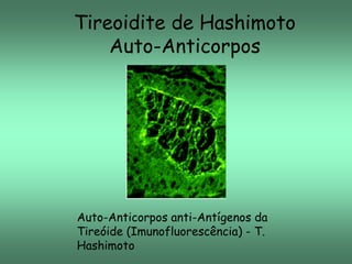 Tireoidite de Hashimoto
Auto-Anticorpos

Auto-Anticorpos anti-Antígenos da
Tireóide (Imunofluorescência) - T.
Hashimoto

 
