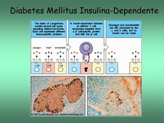 Diabetes Mellitus Insulina-Dependente

 